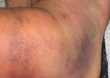 ceballos lesión tobillo